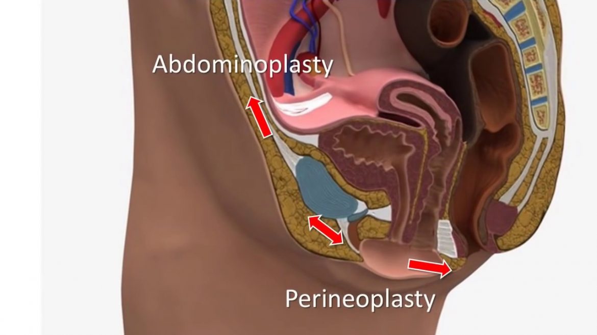 What is vulvoplasty?